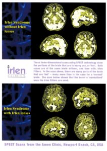 Amen Clinic SPECT Brain Scan poster
